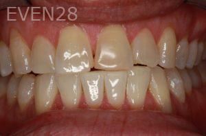 Hermant-Patel-Dental-Crown-before-4