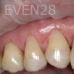 Hermant-Patel-White-Fillings-after-3