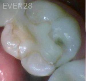 Ian-Rodd-Dental-Crowns-before-1
