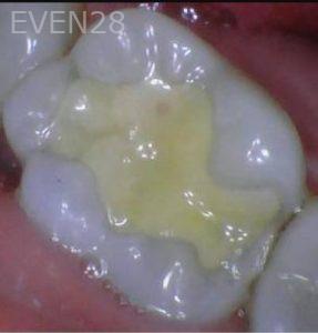 Ian-Rodd-Dental-Crowns-before-2