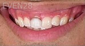 Jason-Ballou-Dental-Crowns-before-1