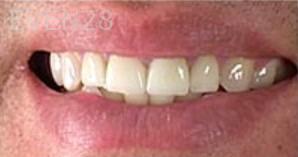 Jason-Ballou-Dental-Implant-after-1
