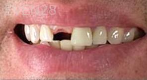 Jason-Ballou-Dental-Implant-before-1