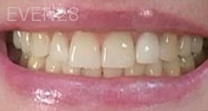 Jason-Ballou-Teeth-Whitening-before-2