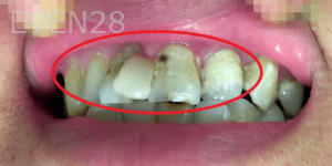 Jefferey-Pham-Dental-Bonding-Before-1