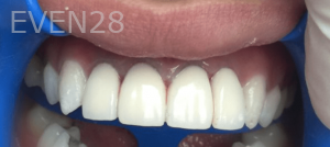 Jefferey-Pham-Dental-Crowns-After-1