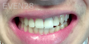 Jefferey-Pham-Dental-Crowns-After-2