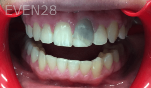 Jefferey-Pham-Dental-Crowns-Before-2