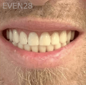 Jefferey-Pham-Dentures-After-1