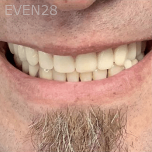 Jefferey-Pham-Dentures-After-2