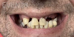 Jefferey-Pham-Dentures-Before-2