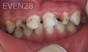 Jefferey-Pham-Pediatric-Dental-Care-Before-1