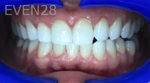 Jefferey-Pham-Teeth-Whitening-After-1