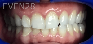 Jefferey-Pham-Teeth-Whitening-Before-1