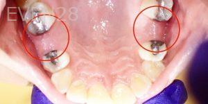Jeremy-Jorgenson-Dental-Implants-before-1