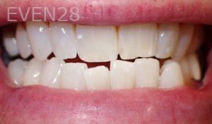 Jeremy-Jorgenson-Teeth-Whitening-after-2