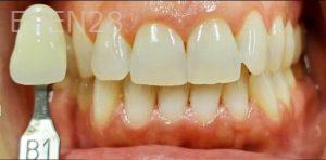 Jeremy-Jorgenson-Teeth-Whitening-before-1