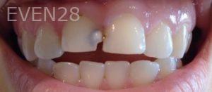 Jerry-Kronquist-Dental-Bonding-before-1