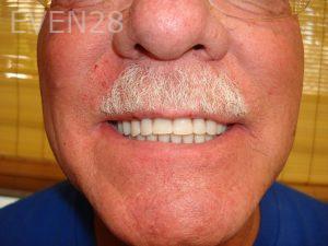 Jerry-Kronquist-Dentures-after-1