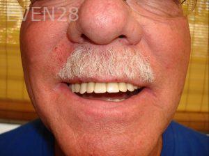 Jerry-Kronquist-Dentures-before-1