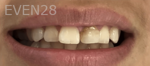 Jocelynn-Vida-Sustaita-Dental-Crown-Before-1