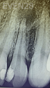 Jocelynn-Vida-Sustaita-Root-Canal-Treatment-Before-1b