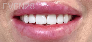 Jocelynn-Vida-Sustaita-Teeth-Whitening-After-1