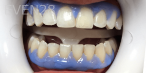 Jocelynn-Vida-Sustaita-Teeth-Whitening-Before-2