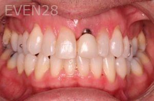 John-Cross-dental-implant-before-1