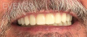 John-Willardsen-All-on-6-Dental-Implants-After-1
