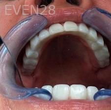 John-Willardsen-All-on-6-Dental-Implants-After-3b