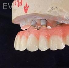 John-Willardsen-All-on-6-Dental-Implants-After-3c