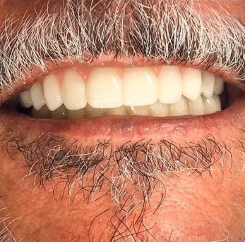 John-Willardsen-All-on-6-Dental-Implants-After-4b