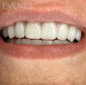 John-Willardsen-All-on-6-Dental-Implants-After-5b