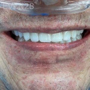 John-Willardsen-All-on-6-Dental-Implants-After-6b