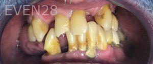 John-Willardsen-All-on-6-Dental-Implants-Before-1