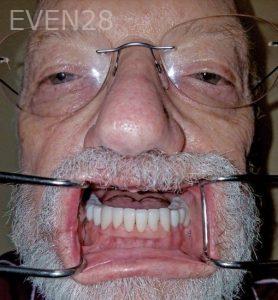 John-Willardsen-All-on-6-Dental-Implants-Before-11