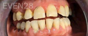 John-Willardsen-All-on-6-Dental-Implants-Before-2