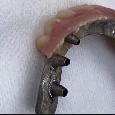 John-Willardsen-All-on-6-Dental-Implants-Before-3b