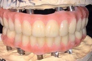 John-Willardsen-All-on-6-Dental-Implants-Before-4c