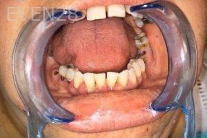 John-Willardsen-All-on-6-Dental-Implants-Before-5