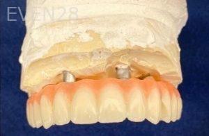 John-Willardsen-All-on-6-Dental-Implants-Before-5c
