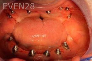 John-Willardsen-All-on-6-Dental-Implants-Before-6b