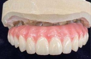 John-Willardsen-All-on-6-Dental-Implants-Before-6c