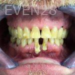 John-Willardsen-All-on-6-Dental-Implants-Before-7b