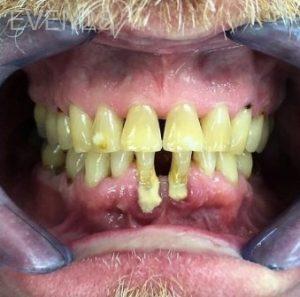 John-Willardsen-All-on-6-Dental-Implants-Before-7b