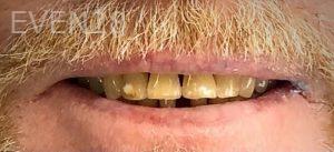 John-Willardsen-All-on-6-Dental-Implants-Before-8