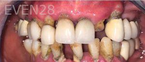 John-Willardsen-All-on-6-Dental-Implants-Before-9