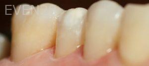 Joyce-Kahng-Dental-Bonding-before-3