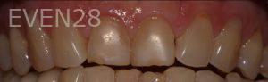 Joyce-Kahng-Porcelain-Veneers-before-2